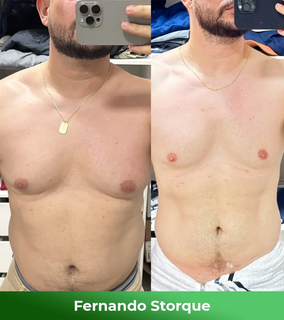 Antes e depois - Fernando Storque